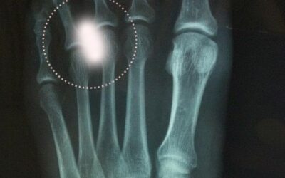 Fisioterapia para Neuroma de Morton