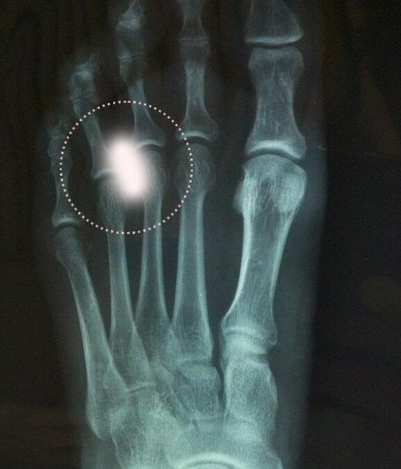 Fisioterapia para Neuroma de Morton