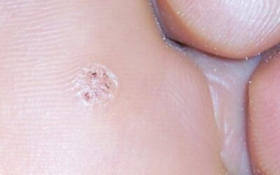 ¿Qué es un Papiloma o Verruga Plantar?
