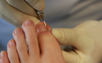 ¿Qué es la uña incarnada u onicocriptosis?